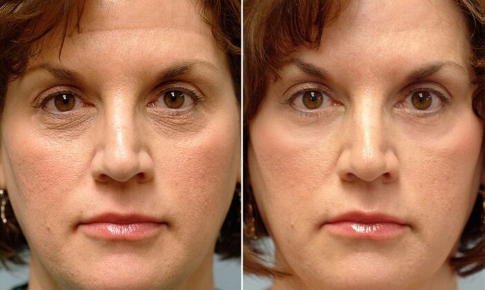 rostro antes y después del rejuvenecimiento fraccionado con láser